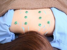 ウル鍼灸整骨院/首肩こりの鍼灸施術