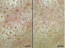 アム バイ オーキッド 代々木公園(UM by ORCHID)/毛穴・ニキビケア