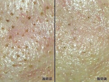 アム バイ オーキッド 代々木公園(UM by ORCHID)/毛穴・ニキビケア