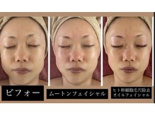 《毛穴綺麗美白》癒しの泡洗浄&ヒト幹細胞毛穴除去コラボ5000円