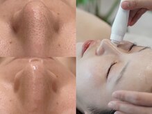 アンリミット 中目黒店(Une limit)/【毛穴悩み、くすみ改善】