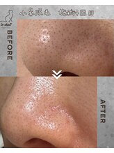 ル シャ/メンズ脱毛/毛穴洗浄/ヘッドスパ