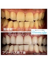 ホワイトニングサロン 福岡天神店/ホワイトニング