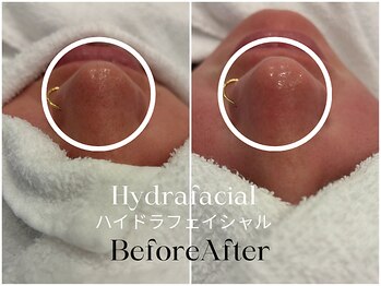 トウキョウビューティーラボ(TOKYO BEAUTY LABO.)/ハイドラBefore&After