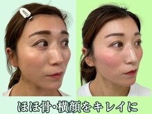 ナチュラルパーフェクトフェイス 新宿/横顔美人・Ｅライン/新宿小顔