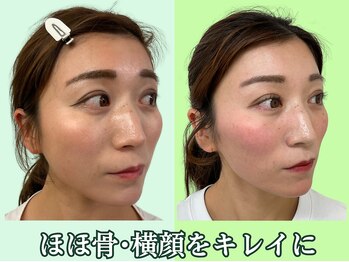 ナチュラルパーフェクトフェイス 新宿/横顔美人・Ｅライン/新宿小顔