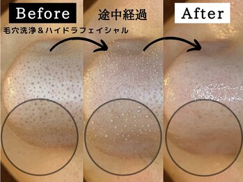 シャルムクリニカルサロン 池袋(Charme clinical salon)/毛穴洗浄＆ハイドラフェイシャル