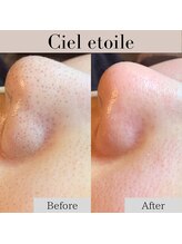 シエルエトワレ/毛穴エクストラクション