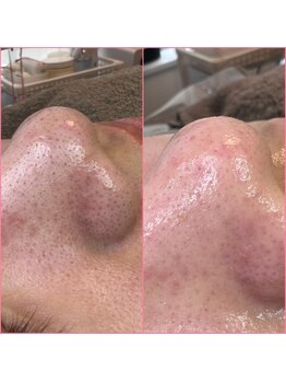 プラスボーテ 幡ヶ谷(plus beaute)/毛穴ケア