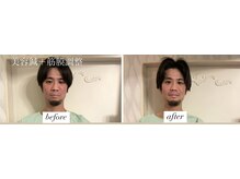 ヤマモト 表参道院(YAMAMOTO)/美容鍼＋筋膜調整　メンズ美容鍼