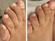 タソニ(DASONI)の写真/【長きにわたる爪のお悩み★人前でも出せる足爪へ】DASONにお任せください！