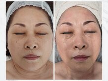 ヴィサージュ 鈴鹿サロン(Visage)/エアバリフェイシャル