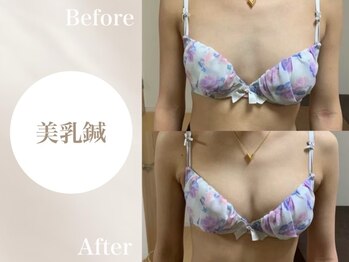 Onはり灸サロン/バストUP美乳鍼before→after