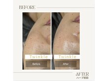 ティンクル(Twinkle)/ほうれい線