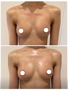 ルフルリール(Refleurir)/◆バストアップ症例/育乳◆