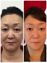 ピーナップ(P-nap)/肌改善ビフォー40代アフター50代