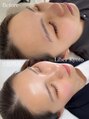 エステティック リベル キョウト 京都駅前店(Esthetic Liber Kyoto)&nbsp;【エステ版ポテンツァ/水光肌注入】韓国人のような水光肌へ。