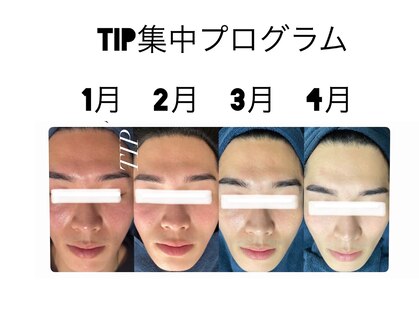 毛穴・エイジングケア専門｜ハーブピーリング｜salonsai｜シミ・美白・たるみの写真