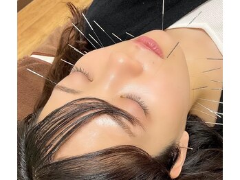 キャンディ鍼灸整骨院の写真/《電気美容鍼でお肌トラブル改善♪》頬のたるみを改善したい方・リフトアップしたい方必見!40分¥3980♪