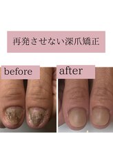 ティアラネイル(tiaranail)/再発させない深爪矯正