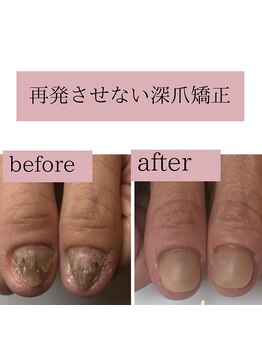 ティアラネイル(tiaranail)/再発させない深爪矯正