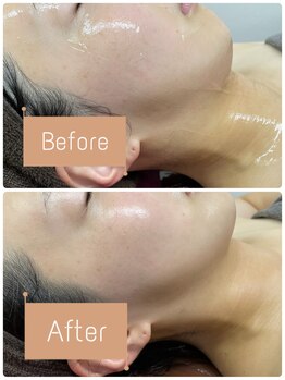 FJ/本来のフェイスラインへ