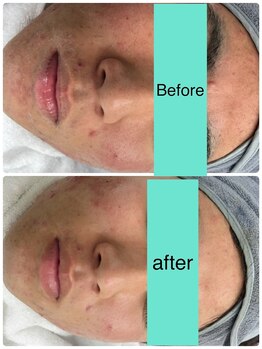 アスピリア(aspirer a')/ハーブピーリング