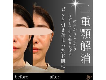 チョコバリ 郡山店(chocobari)/小顔×リフトアップ(美容鍼)20代