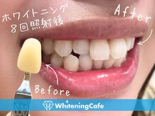 ホワイトニングの症例写真はフォトギャラリーをCheck！