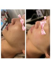 美温(mion)/インディバ×レッドショット