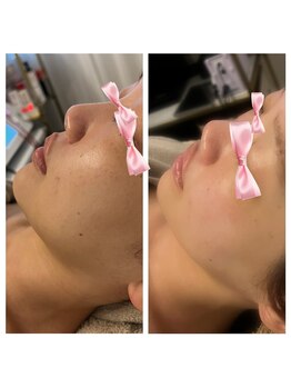 美温(mion)/インディバ×レッドショット