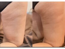 リブラ(LIBRA)/セルライトもすっきり