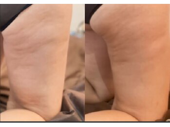 リブラ(LIBRA)/セルライトもすっきり