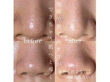 ソワ 吉塚店(soi)の雰囲気（角栓の詰まりからからくる汚れはしっかり落とす！毛穴汚れオフ♪）