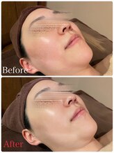 ビューティースタイリング 自由が丘店(beauty styling)/【美白ピーリング】