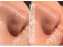 シューラディアント(ShuRadiant)/毛穴ケア/毛穴洗浄/ハイドロ