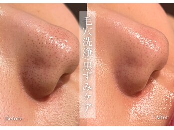 シューラディアント(ShuRadiant)/毛穴ケア/毛穴洗浄/ハイドロ