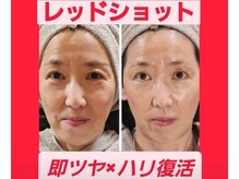 アン 銀座(ann)の雰囲気（フェイスラインが綺麗になると鏡を見ることが増えます。満足！！）