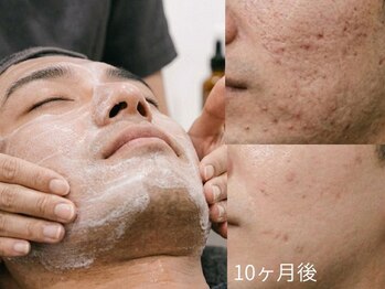 ラ コケット(La Coquette)の写真/ベタつき・ニキビ・毛穴に◎男性も綺麗が良いに決まってる！身だしなみで好感度UP☆清潔感溢れる勝負肌へ♪
