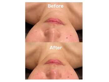 エレーナ(ELENA)/小顔コルギ30分