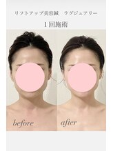 めい鍼灸院/美容鍼×LED光でハリツヤアップ