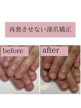 ティアラネイル(tiaranail)/再発させない深爪矯正