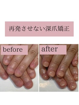 ティアラネイル(tiaranail)/再発させない深爪矯正