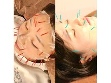 つつじが丘整骨院鍼灸マッサージ院の雰囲気（豊富な美容鍼メニューからお悩みに沿ったご提案を致します！）