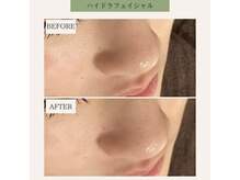 ライム(LIME)/ハイドラフェイシャル