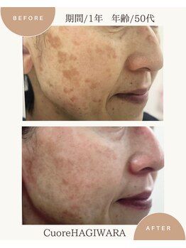 クオーレ ハギワラ(cuore HAGIWARA)/肌質改善/しみ・くすみ・たるみ