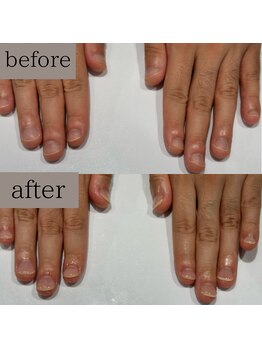 ティアラネイル 宇都宮/深爪矯正