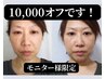 【モニター募集】再生美容コース TGF導入 小顔矯正 13,900円→3,900円