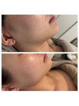 美温(mion)/インディバ×レッドショット