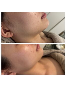 美温(mion)/インディバ×レッドショット